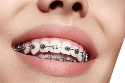 ¿cómo Se Colocan Los Brackets De Un ‘aparato’ Dental Vélez And Lozano