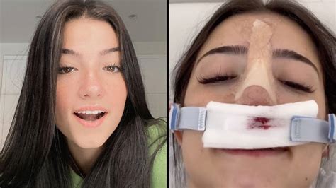Текст этой книги доступен онлайн: Charli D'Amelio reveals why she got surgery on her nose ...