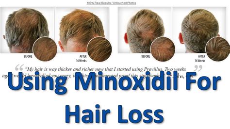 Using Minoxidil For Hair Loss For Men Only Youtube