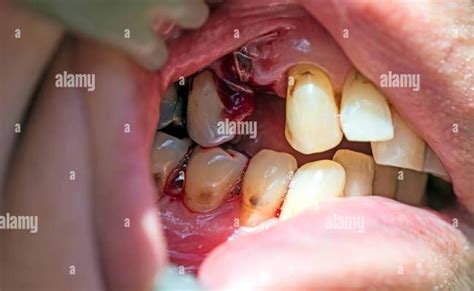 Wisdom Teeth Blood Clot Picture Teethwalls Otosection