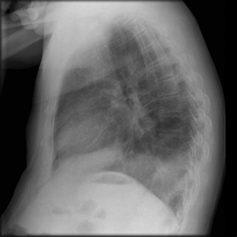 Right Lower Lobe Collapse Image