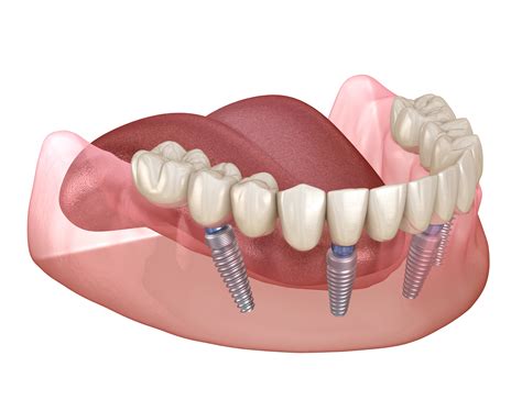 Dental Implants What To Expect Savannah Dental Solutions