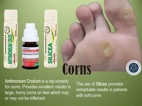 Doctor Recommended Homeopathic Medicines For Corns Treatment