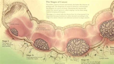 Symptoms Of Colorectal Cancer And The Importance Of Catching It Early