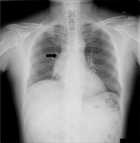 Chest X Ray Indicating Enlargement Of The Right Hilar A Open I