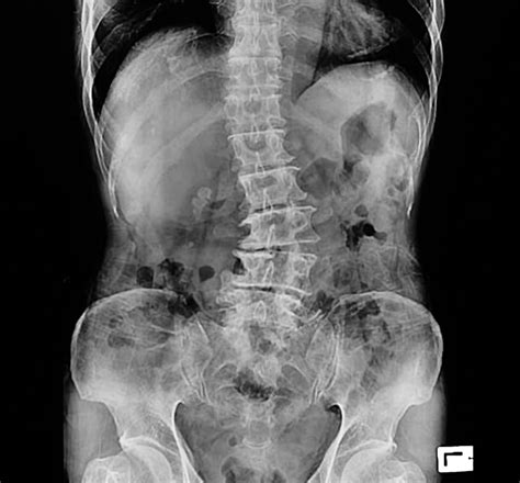 Your lower back has a unique anatomy made up of different types of tissues, including bones, muscles, ligaments, nerves, and blood vessels. Scoliosis Awareness Month | Texas Back Institute