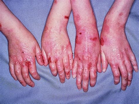 Enfermedades Raras Epidermólisis Bullosa