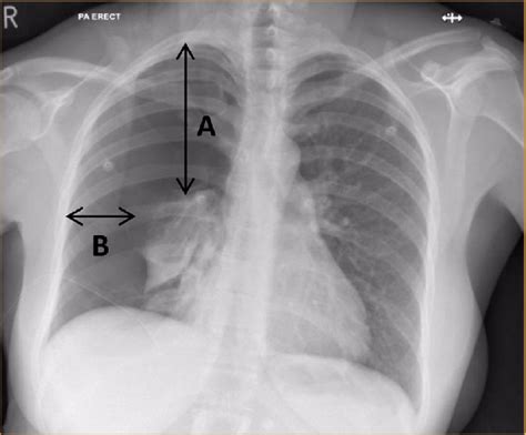 Depth Of Pneumothorax A Apex To Cupola Distance American