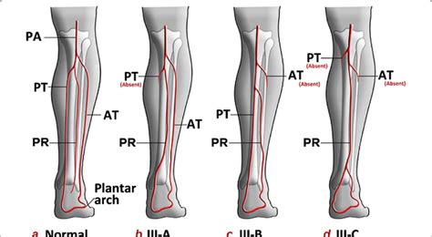 Normal And Dominant Peroneal Artery Infra Popliteal Branching Patterns