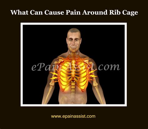 Pain Around Rib Cagecausessymptomstreatmentcomplications