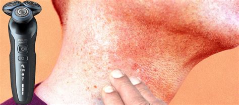 Electric Razor Burn Why It Happens And How To Get Rid Of It