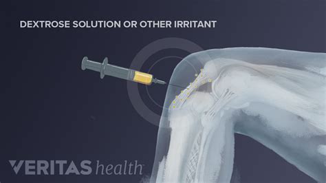the benefits of prolotherapy injections for knee osteoarthritis