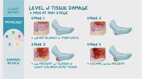 Pressure Injury Stages Pressure Ulcer Staging Interna Vrogue Co