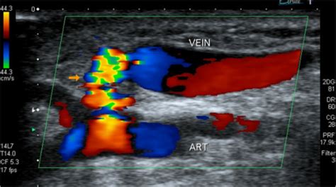 An Ultrasound Scan Of The Right Radial Artery Revealed Open I