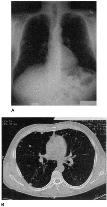 Prostate Carcinoma Presenting As Multiple Pulmonary Nodules In An
