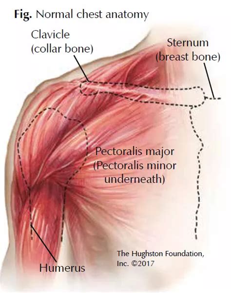 Chest Muscle Injuries Strains And Tears Of The Pectoralis Major — The