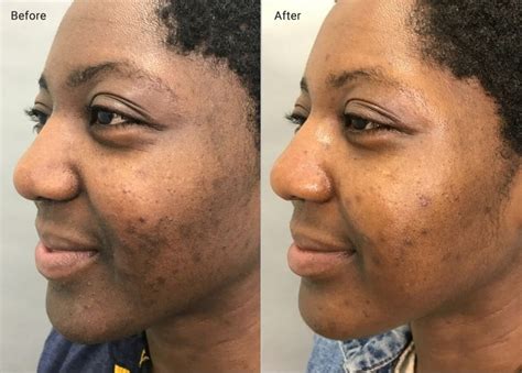 Microneedling For Hyperpigmentation Efficacy Side Effects And More