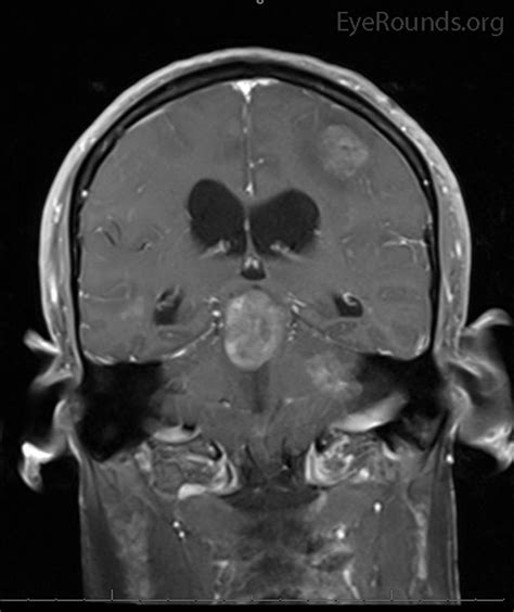 Bilateral Internuclear Ophthalmoplegia And Thalamic Esotropia The