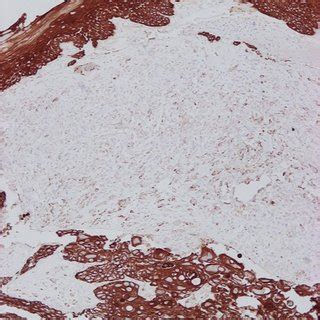 Leukoplakia is a condition in which thick, white or grayish patches form usually inside your mouth. A mass emanating from the supraglottic part of larynx ...