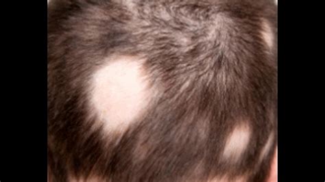 Major Causes Of Bald Spots That Every Woman Should Be Aware Of Youtube
