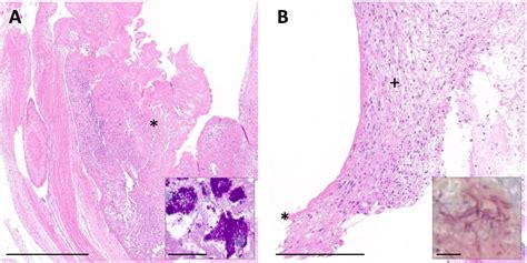 Bacterial Endocarditis Histology