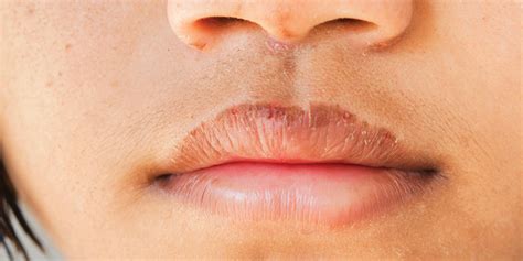 Bibir Kering Dan Gatal Penyebab Dan Cara Mengatasinya