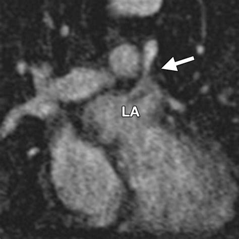 Paradoxical Embolism Role Of Imaging In Diagnosis And Treatment