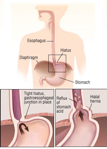 Hiatal Hernia Guide Causes Symptoms And Treatment Options