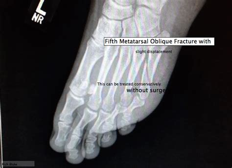 Foot And Ankle Problems By Dr Richard Blake Fifth Metatarsal Oblique