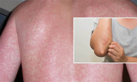 Images Of Viral Rashes MyWeb