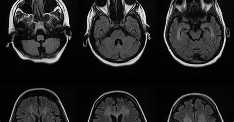Dr Balaji Anvekar Frcr Vit B12 Deficiency Mri Brain Findings