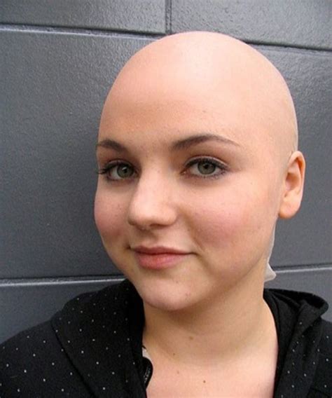 What Is The Difference Between Alopecia Universalis And Alopecia