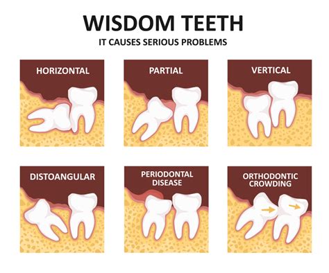 Destruir Cálculo Depósito Wisdom Tooth Extraction Healing Process