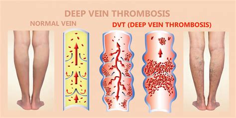 Deep Vein Thrombosis Read About Causes Of Dvt What Is Dvt And Dvt Vs