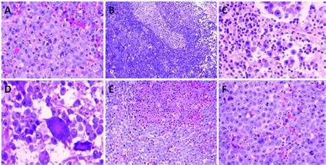 Histopathologic Features Of Alk Positive Diffuse Large B Cell Lymphoma