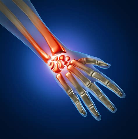 Orthopedic Hand And Wrist Surgery In Plano Frisco Mckinney And Allen