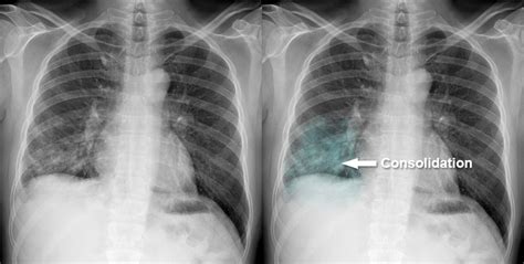 Chest X Ray Pulmonary Disease Consolidation Zonal