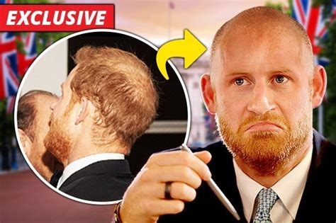 Is Prince Harry Wearing Hair Loss Concealer Biothik