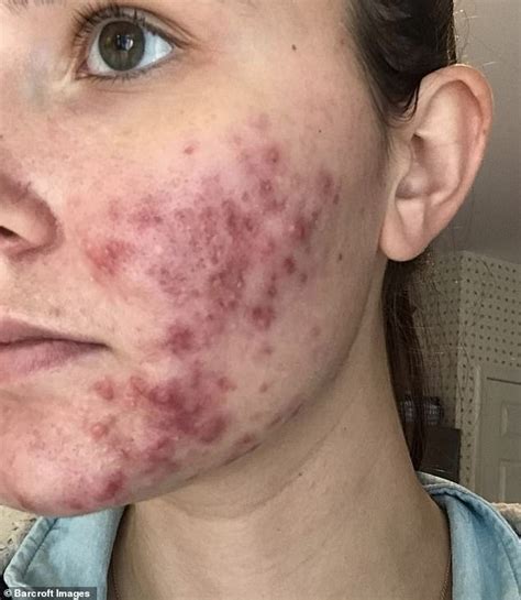 Stylist With Severe Cystic Acne Goes Out Without Makeup For The First Time Daily Mail Online