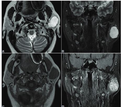 Preoperative Diagnosis Of Parotid Gland Tumors Imaging And Cytologic