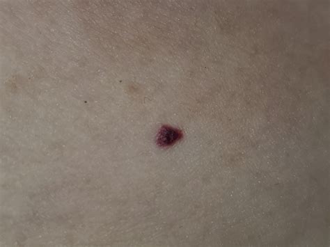 Cant Tell If This Is A Small Blood Blister Or Something Else R