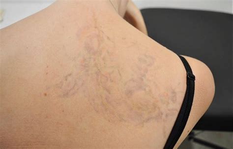 The Wheres Whats And Hows Of Tattoo Removal In Singapore