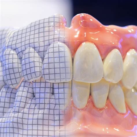 Cuanto Cuesta Una Protesis Dental Clinica Nudent Trujillo