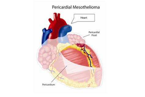 Pericardial Mesothelioma Signs Causes Treatment