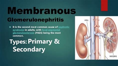 Membranous Glomerulonephritis