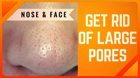 Large Pores Treatment How To Get Rid Of Large Pores On Nose And Face In