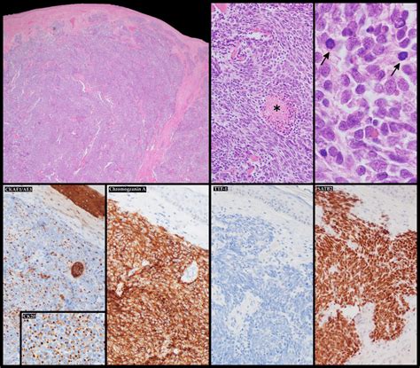 Merkel Cell Carcinoma Histological Features With Its Typical