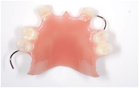 Removable Prosthodontics Partial And Complete Dentures Dental Trends