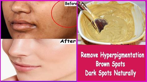 Natural Home Remedy To Clear Your Skin Of Dark Spots Or