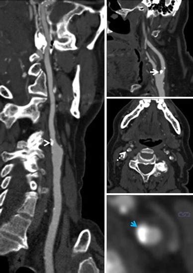 Ct Angiography Of The Carotid Arteries Showing Calcified Plaque Of The